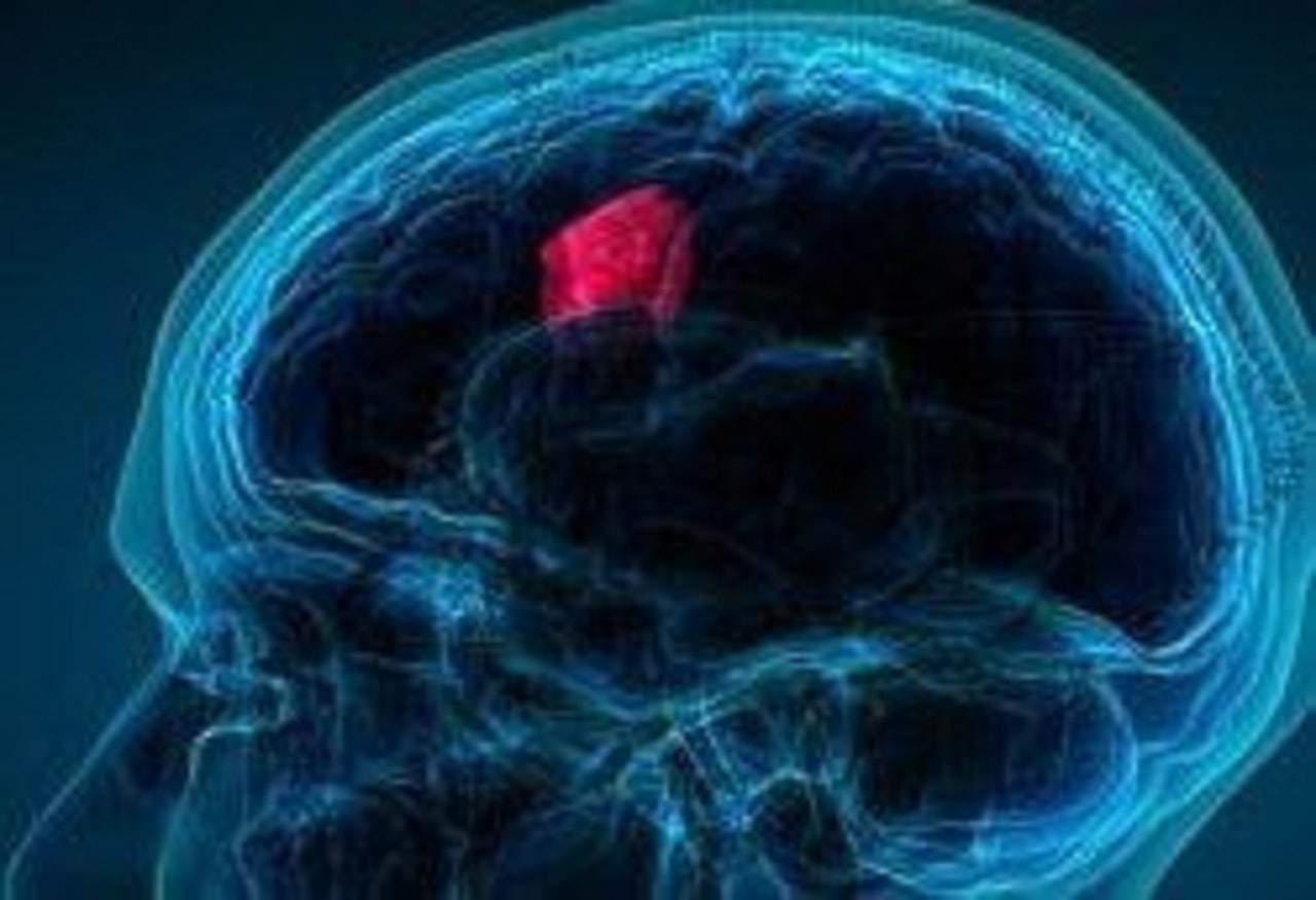 ¿Cuáles son las señales de advertencia reales de un tumor cerebral? 1